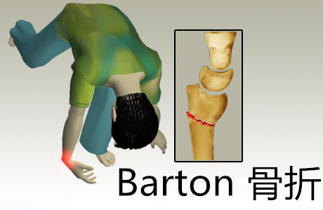 桡骨远端关节面纵斜型骨折,伴有腕关节脱位.