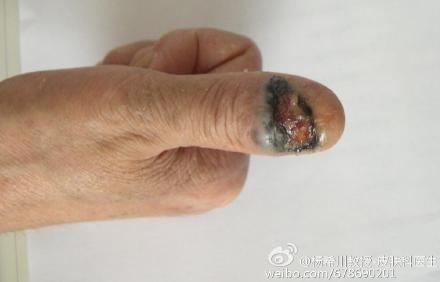 指甲现黑斑别慌不一定是恶性瘤