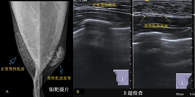 讲座男性乳房发育症