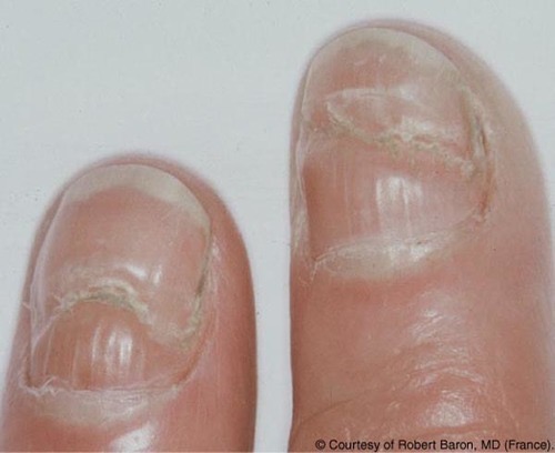 指甲上的“神秘”横线