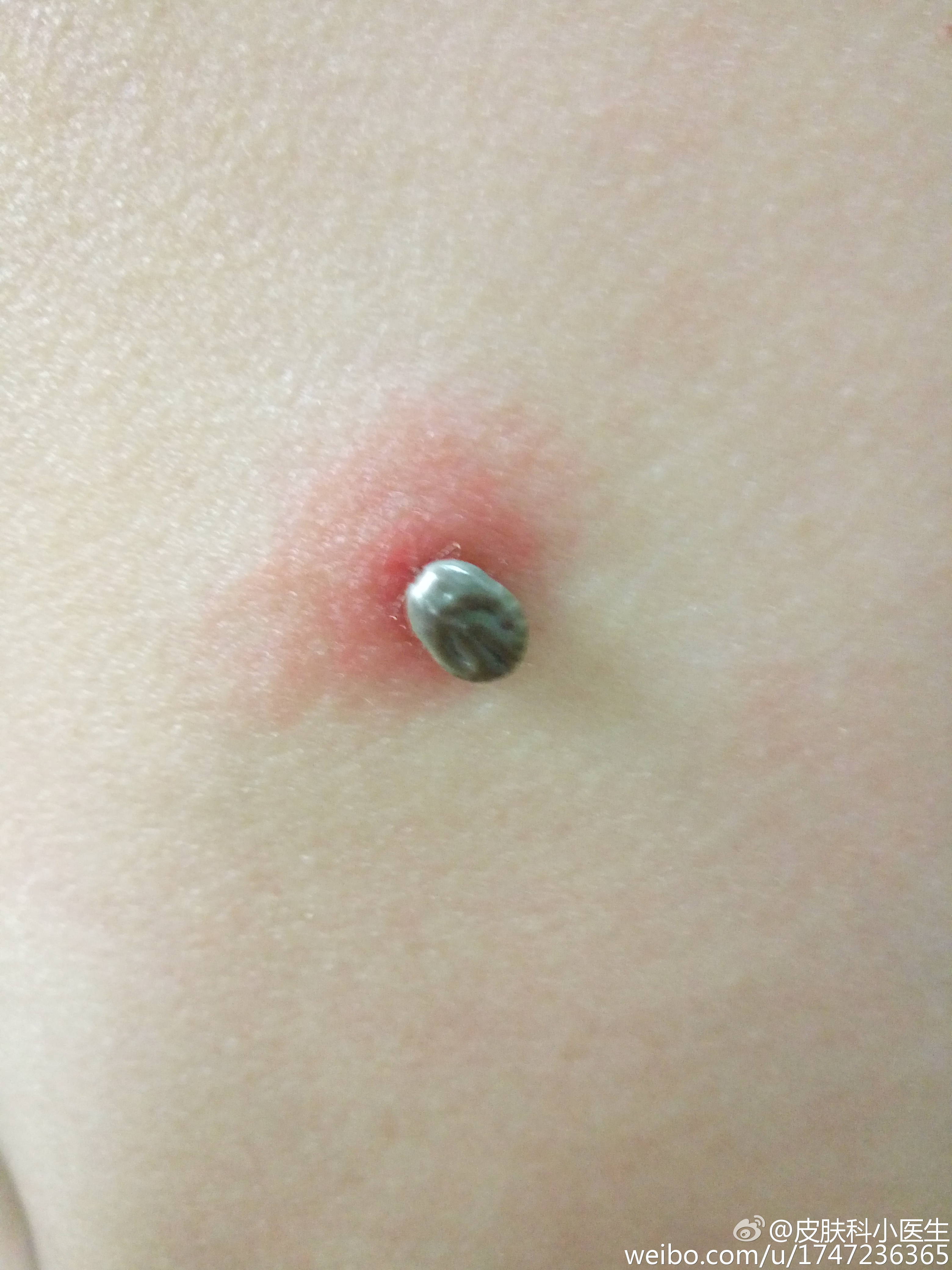 图1是蜱虫扒在患者背部皮肤上