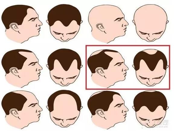 《管好头等大事》脱发(杨希川电视访谈)_好大