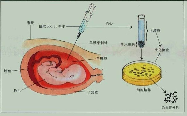 羊水穿刺and脐带穿刺