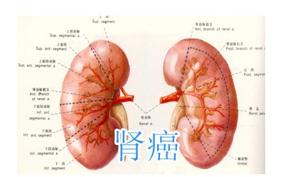 肾癌的手术治疗
