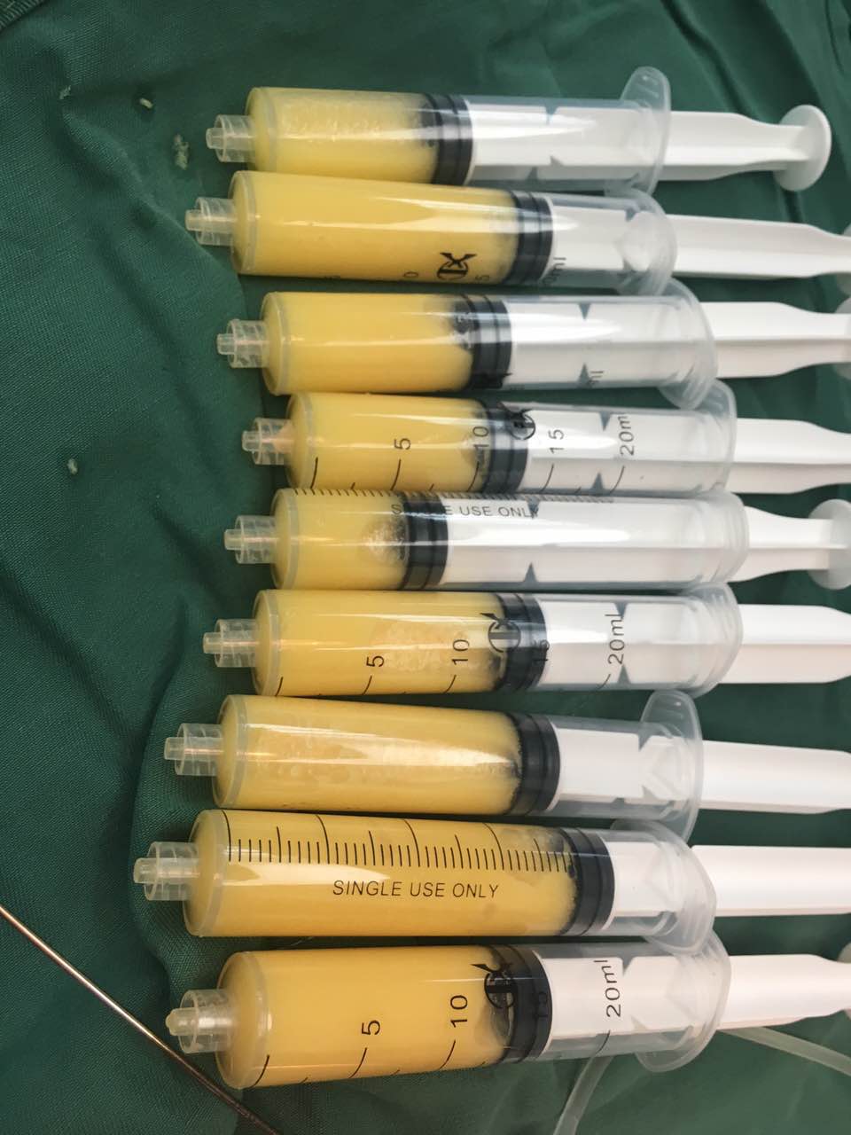 6,自体脂肪移植对局部脂肪堆积较多的人,除了做面部塑形, 丰胸的同时