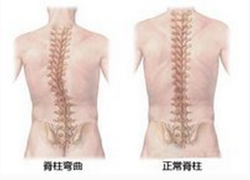 脊柱侧弯矫正手术的简单介绍