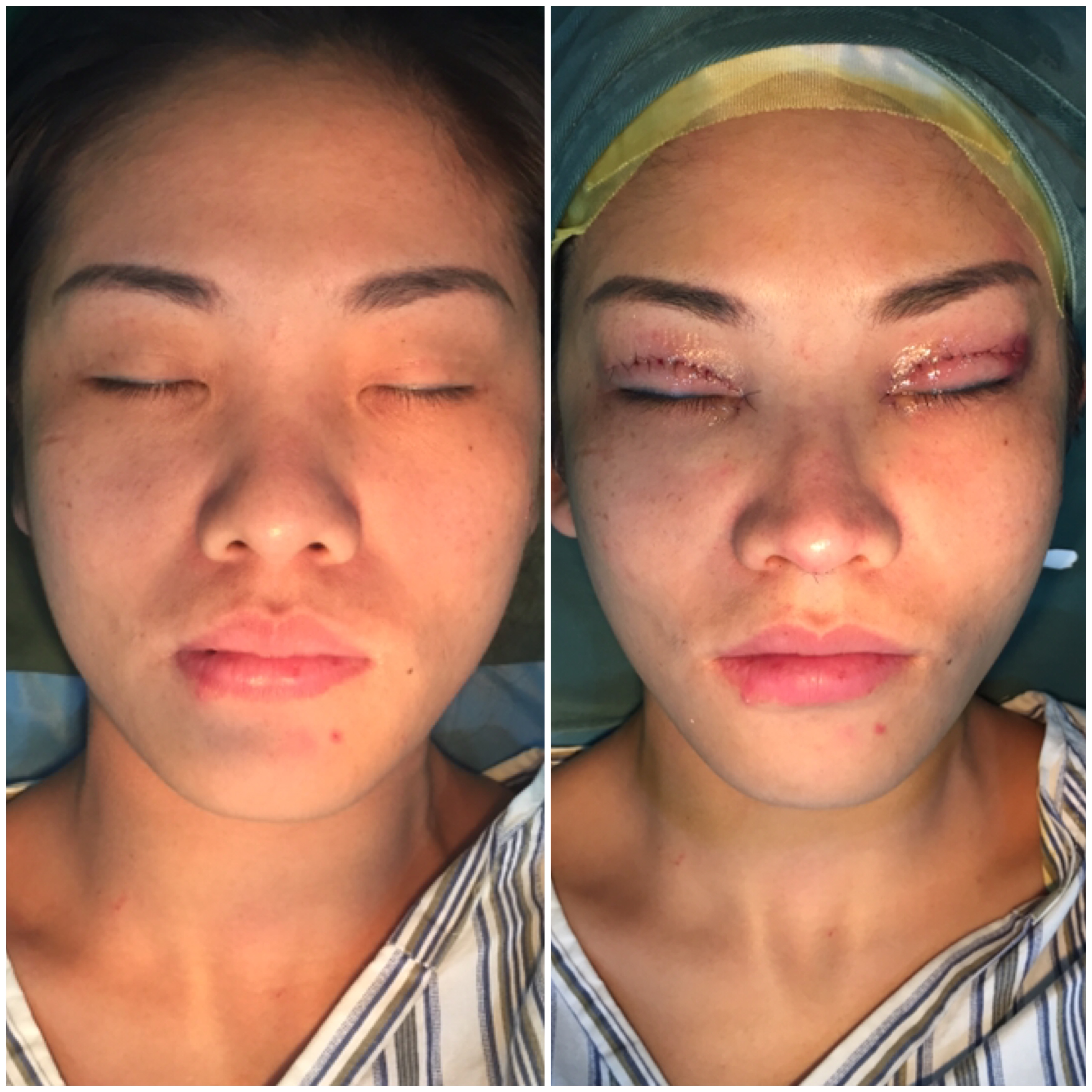 一人一鼻#手术当即效果,困扰姑娘的问题是双眼皮和鼻子的问题,@新浪