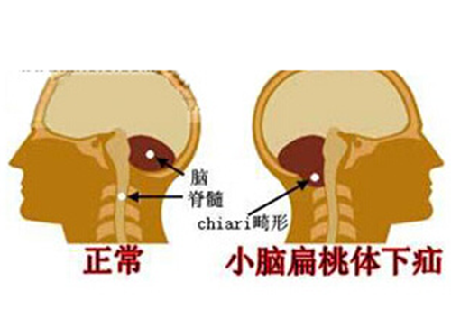 枕骨大孔疝图片