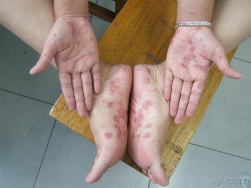 梅毒皮疹图片手脚图片